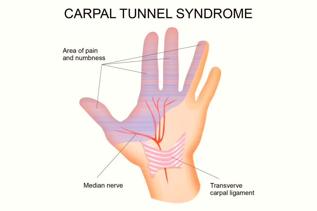 What is carpal tunnel syndrome? 